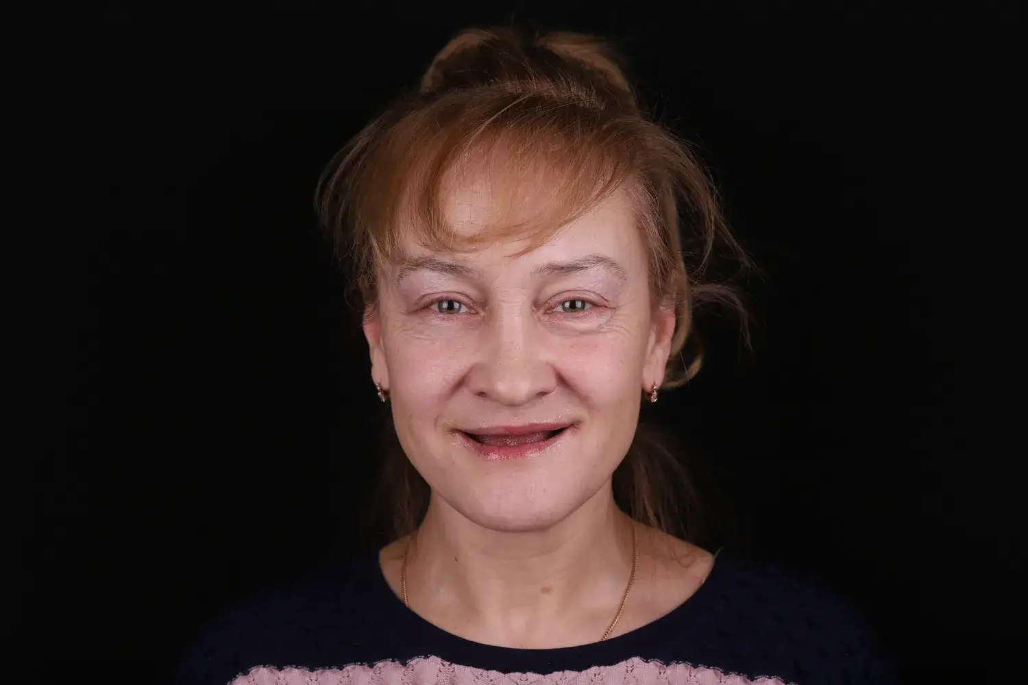 Пациент до и после лечения - случай 2