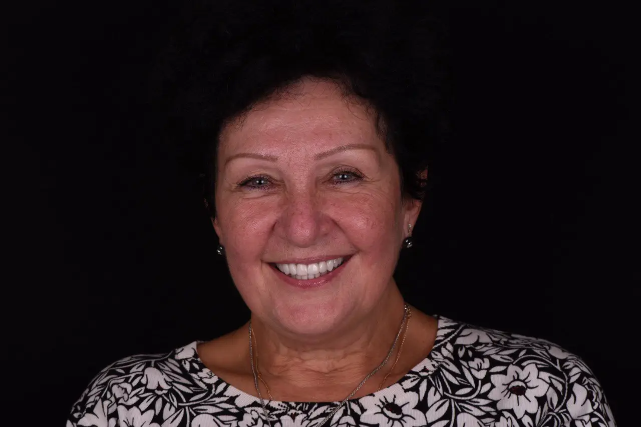 Пациент до и после лечения - случай 4